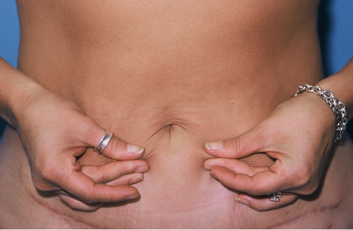 TummyTuckPatient1AFTER_PT-19199
