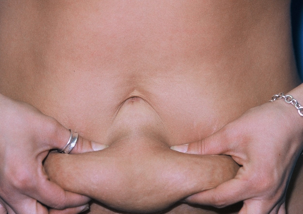 TummyTuckPatient1BEFORE_PT-19199