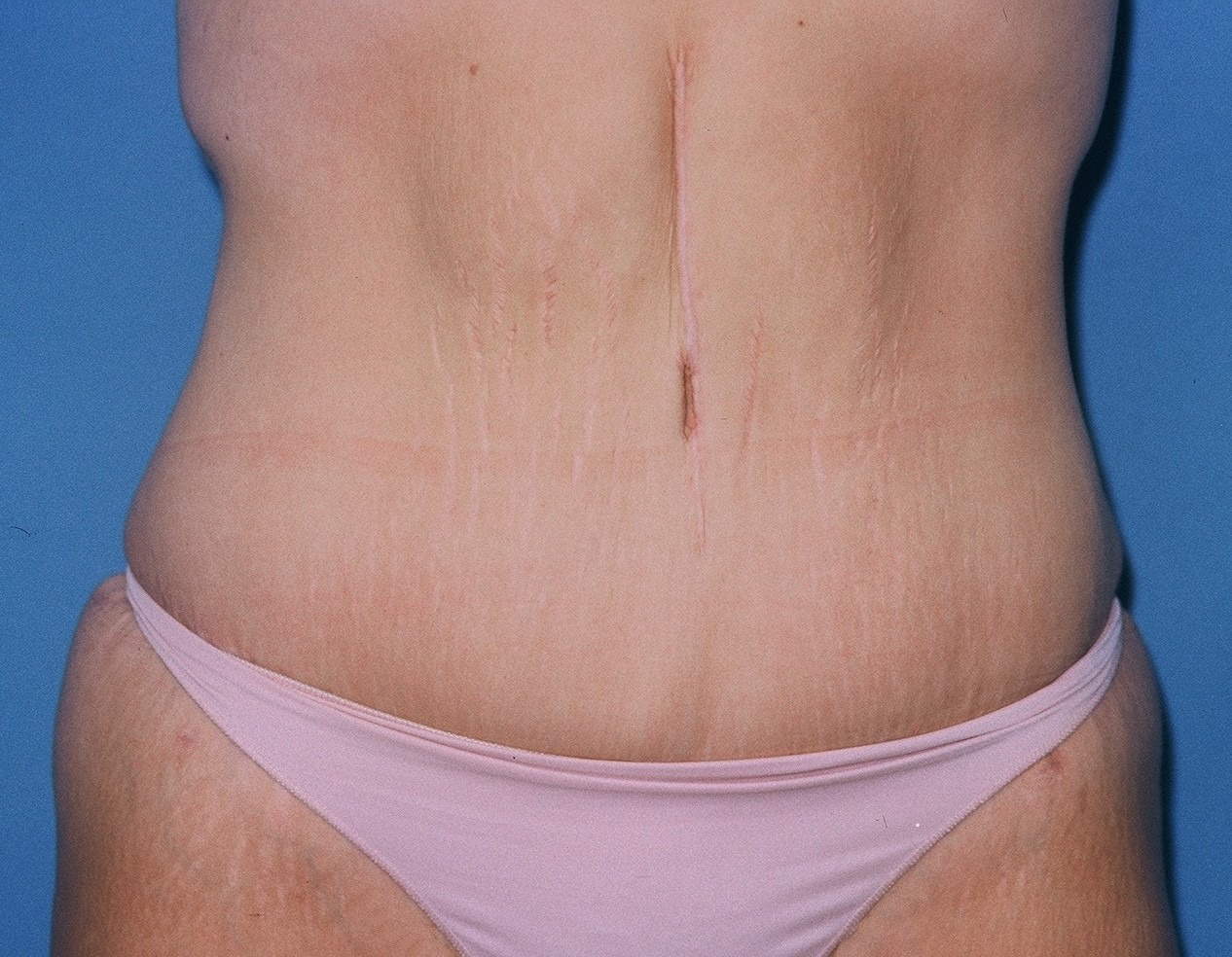 TummyTuckPatient2AFTERFRONT_PT-19199