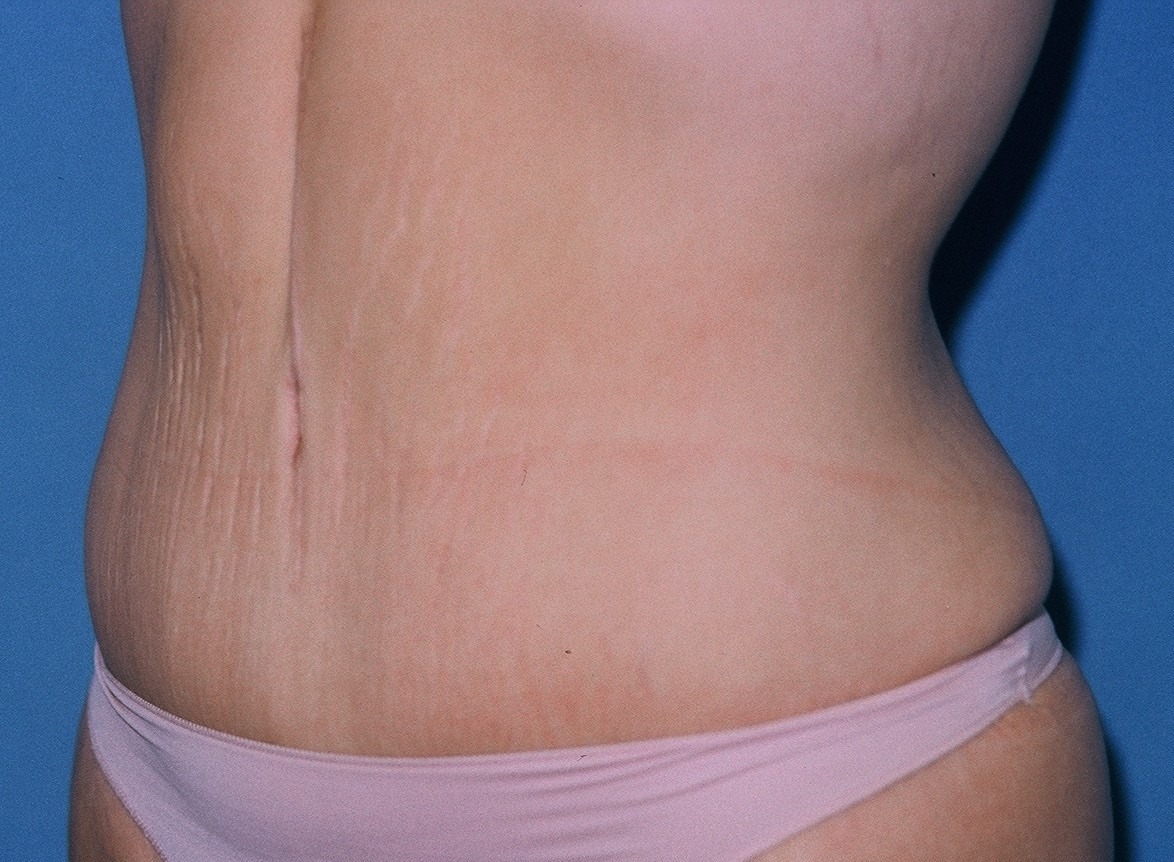 TummyTuckPatient2AFTEROBLIQUE_PT-19199