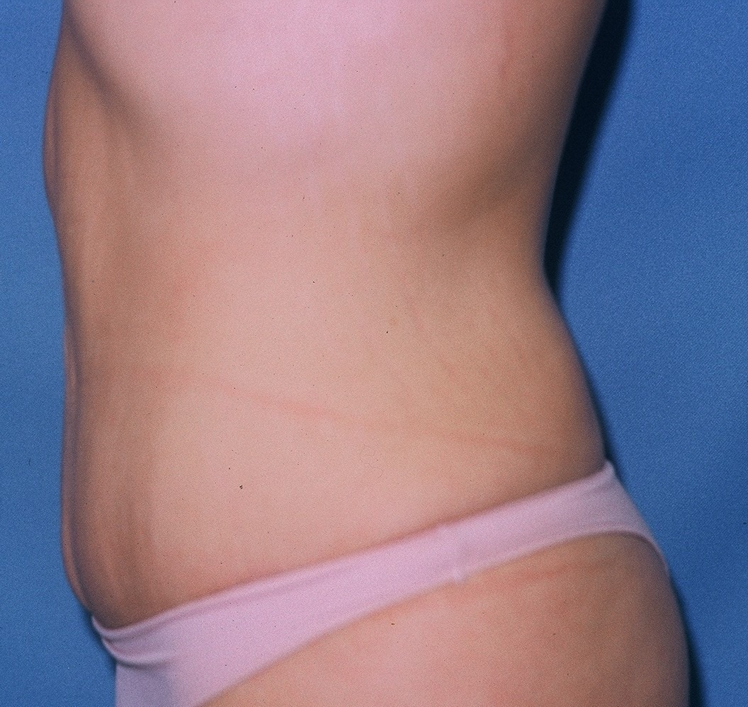 TummyTuckPatient2AFTERSIDE_PT-19199.jpg