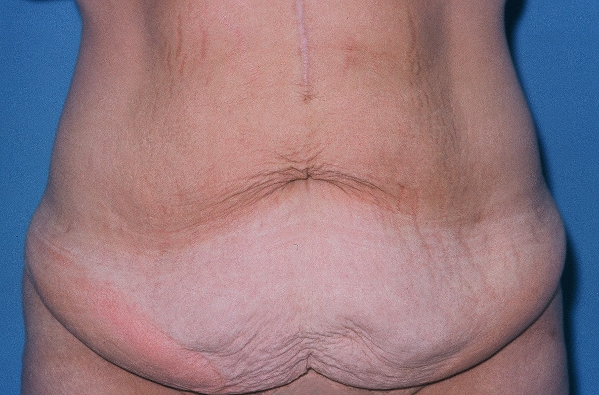 TummyTuckPatient2BEFOREFRONT_PT-19199