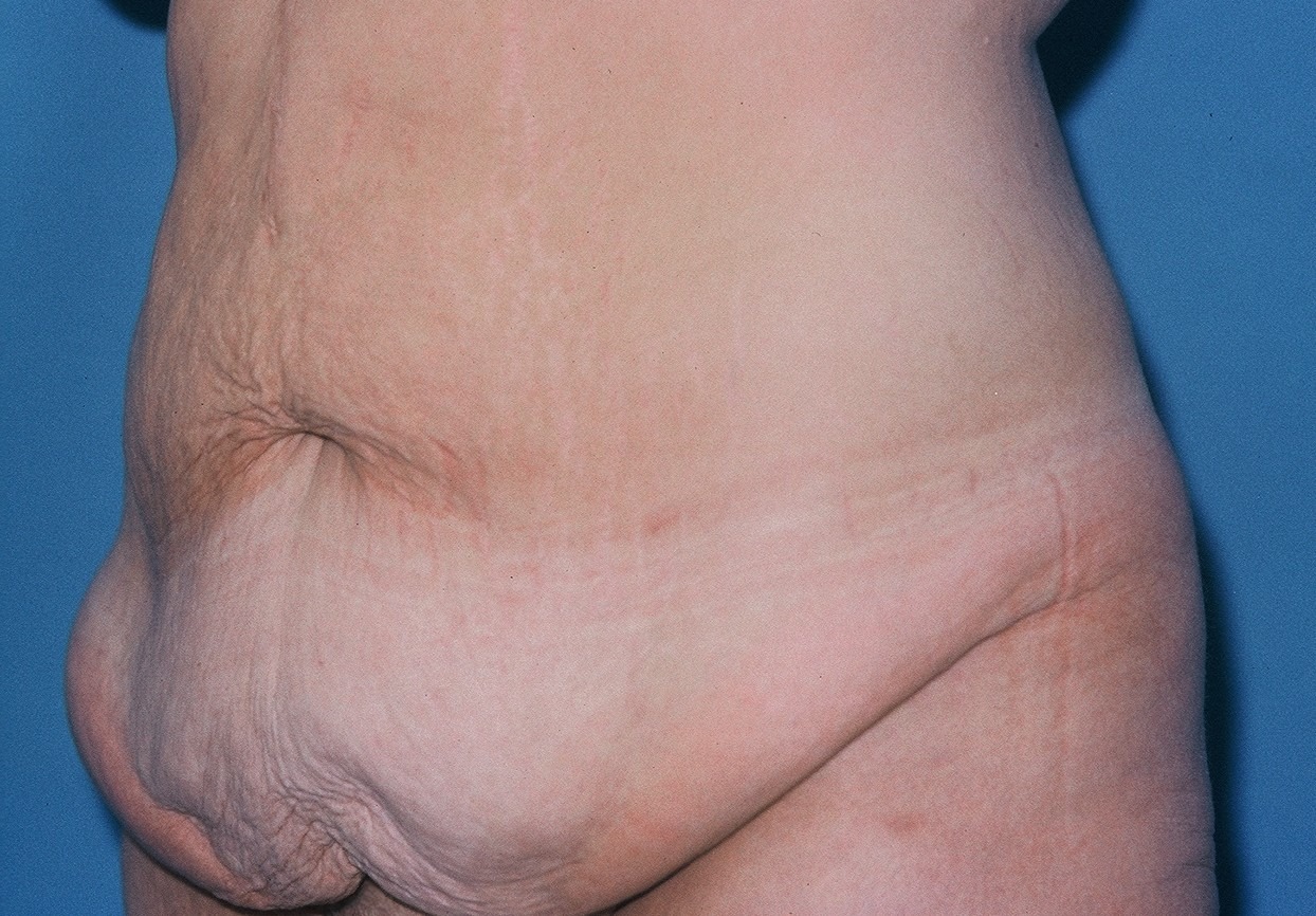 TummyTuckPatient2BEFOREOBLIQUE_PT-19199