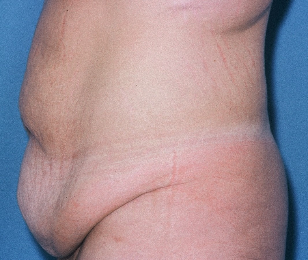 TummyTuckPatient2BEFORESIDE_PT-19199