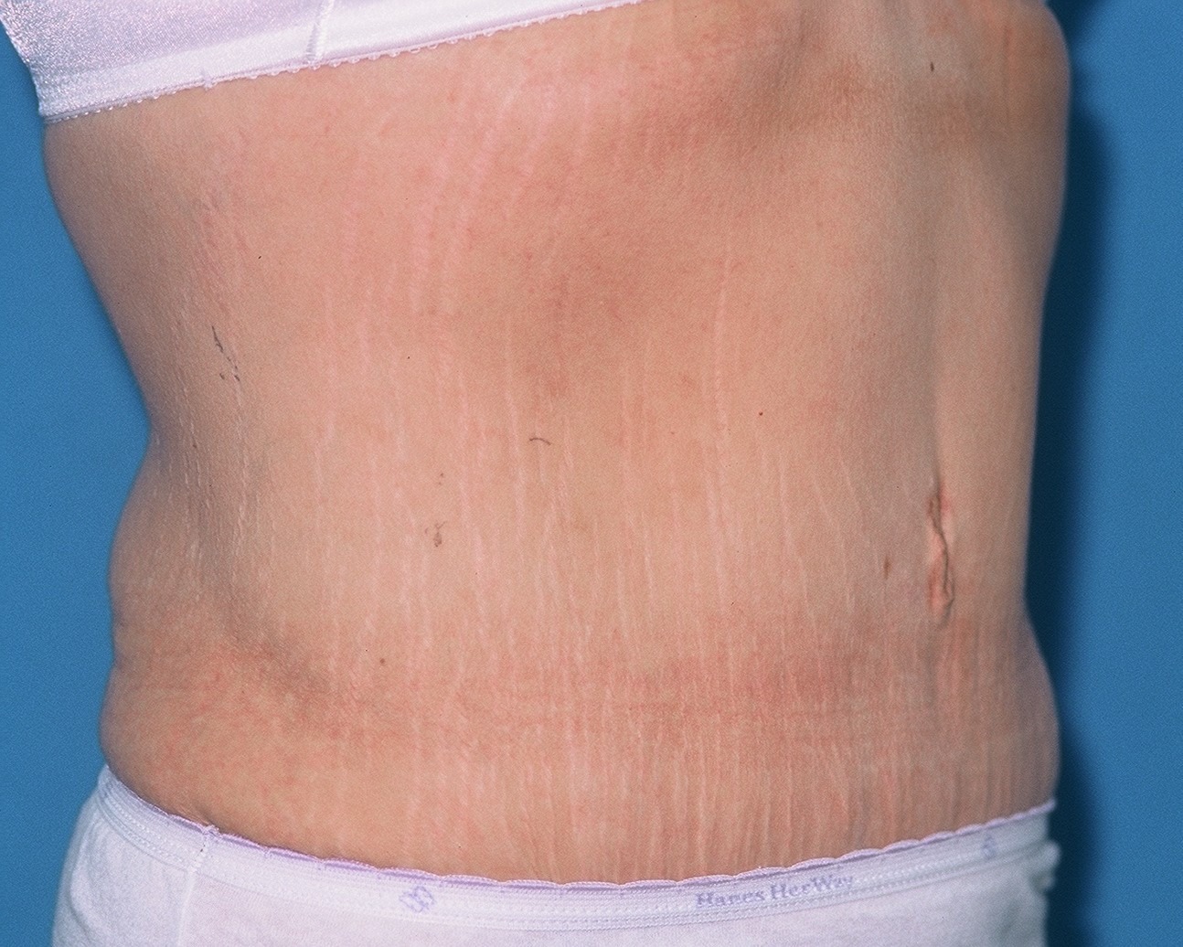 TummyTuckPatient3AFTEROBLIQUE_PT-19199