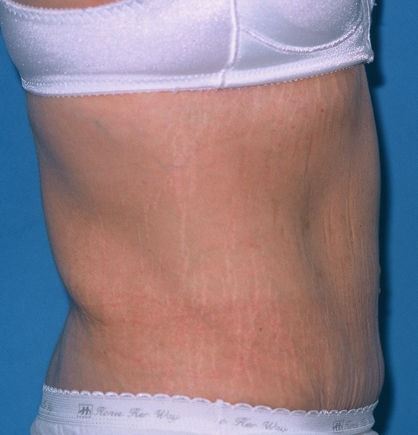 TummyTuckPatient3AFTERSIDE_PT-19199