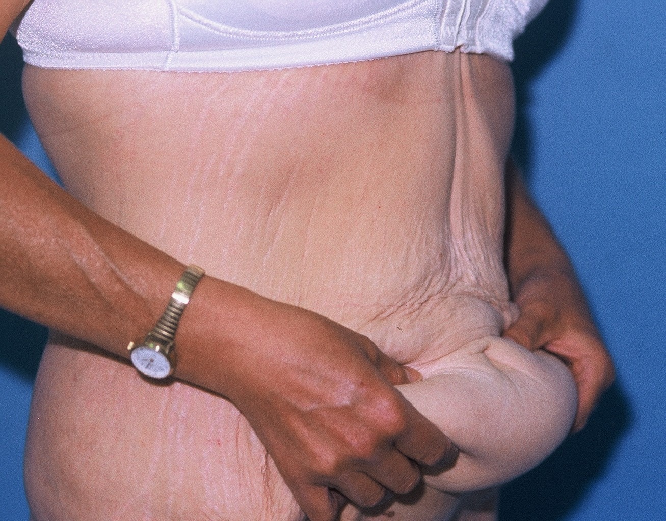 TummyTuckPatient3BEFOREOBLIQUE_PT-19199