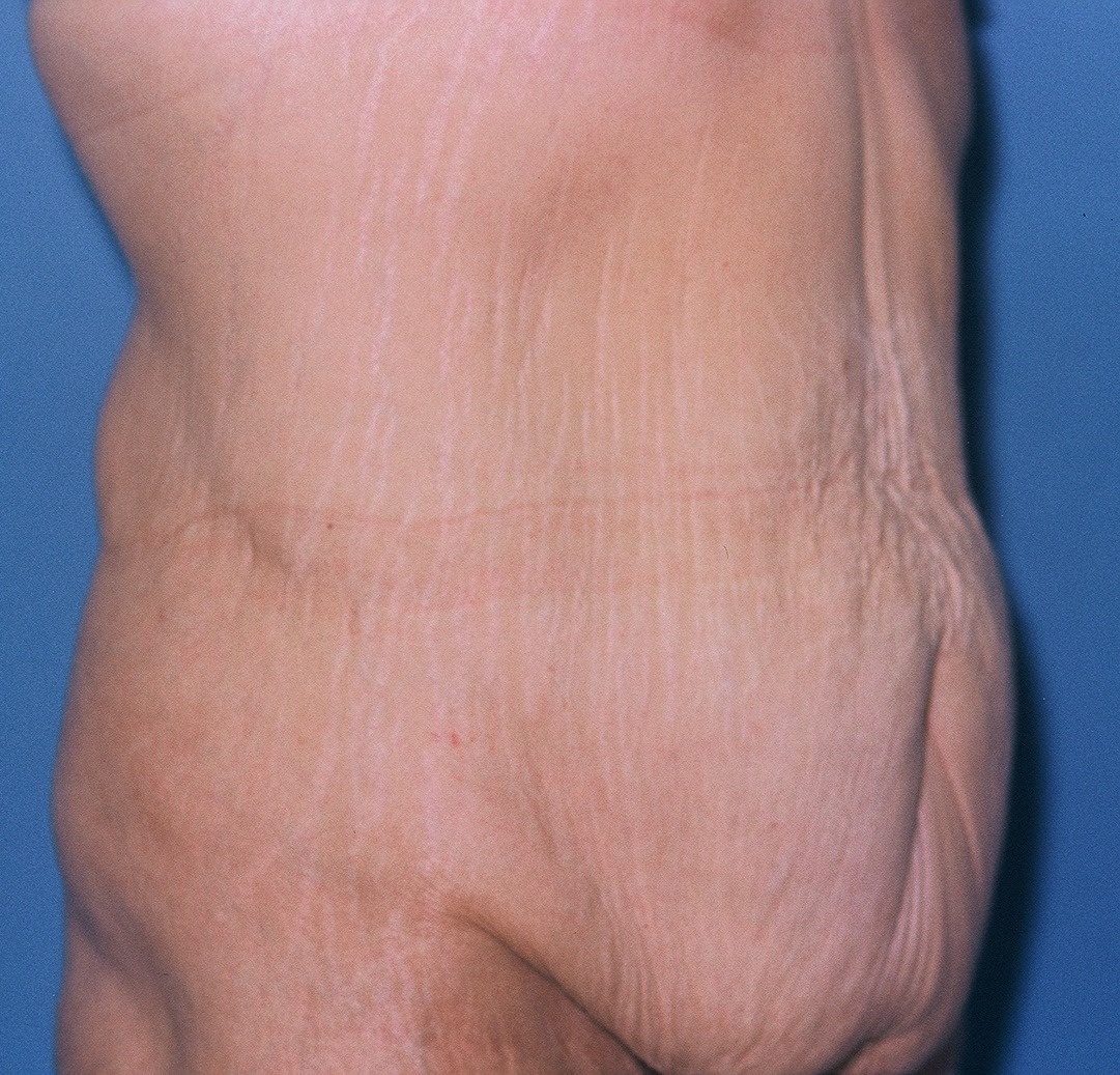 TummyTuckPatient3BEFORESIDE_PT-19199